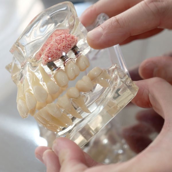 Implant Surgery