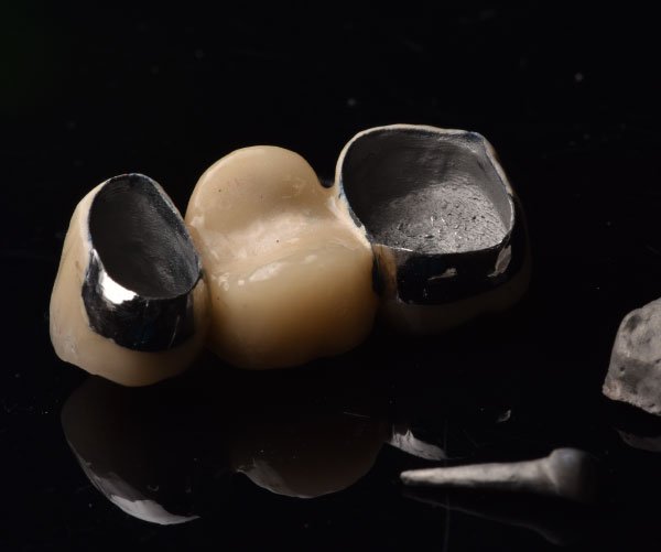 PFM Crowns